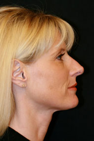 Classic Facelift Before & After