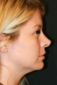 Classic Facelift Before & After