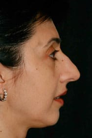 Classic Facelift Before & After