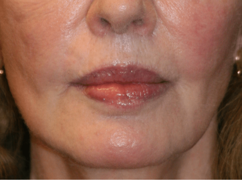 Classic Facelift After & After