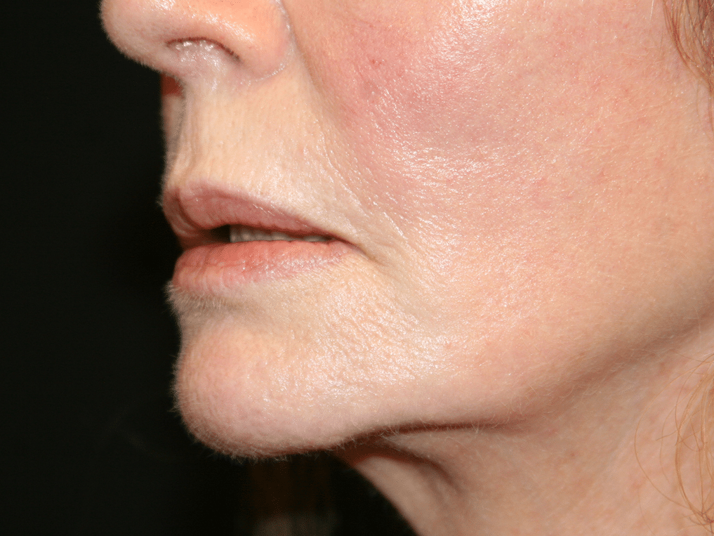 Classic Facelift Before & After