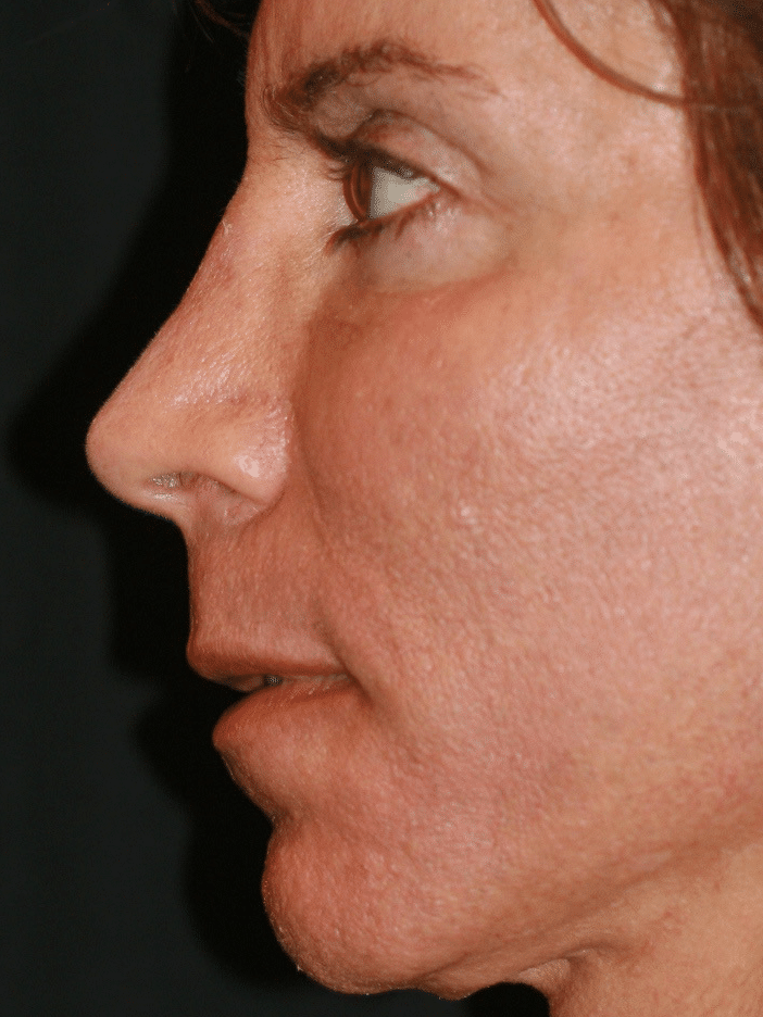 Classic Facelift Before & After