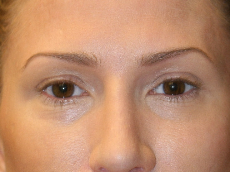 Classic Facelift Before & Before