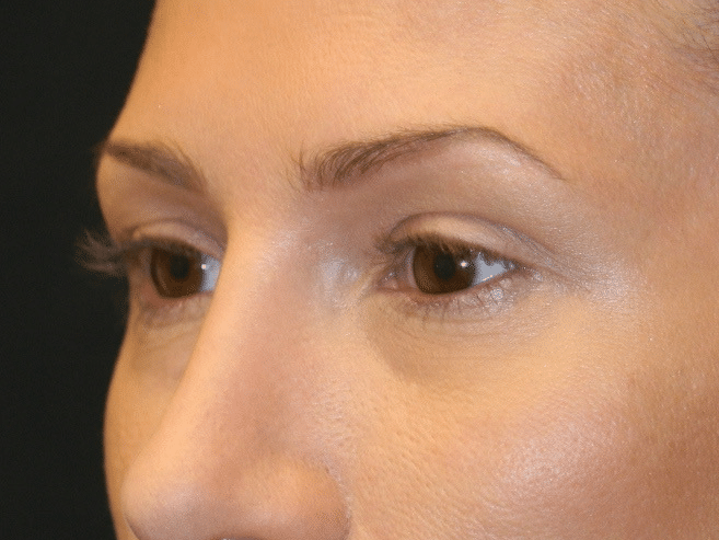 Classic Facelift Before & After