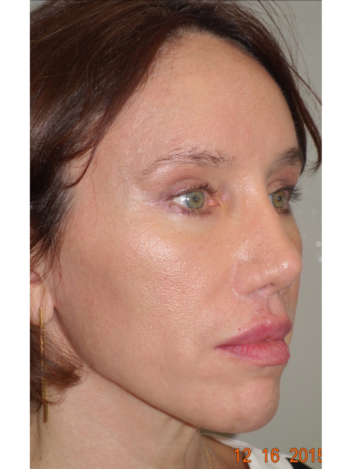 Classic Facelift After & After