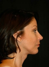 Classic Facelift After & After