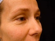 Classic Facelift Before & After