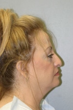 Classic Facelift Before & Before