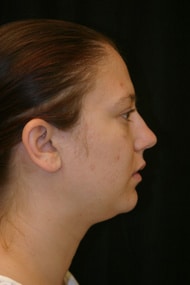 Classic Facelift Before & After