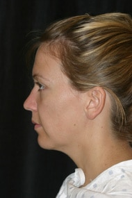 Classic Facelift Before & Before