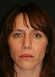 Classic Facelift Before & Before