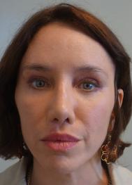 Classic Facelift After & After