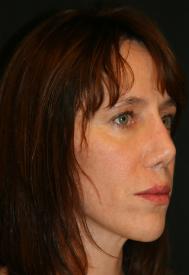 Classic Facelift Before & After