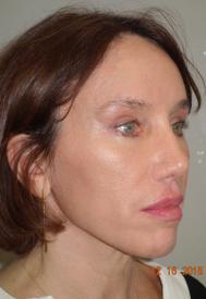 Classic Facelift After & After