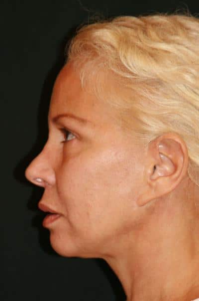 Classic Facelift Before & After