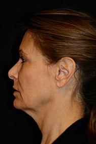 Classic Facelift Before & After