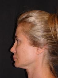 Classic Facelift Before & After