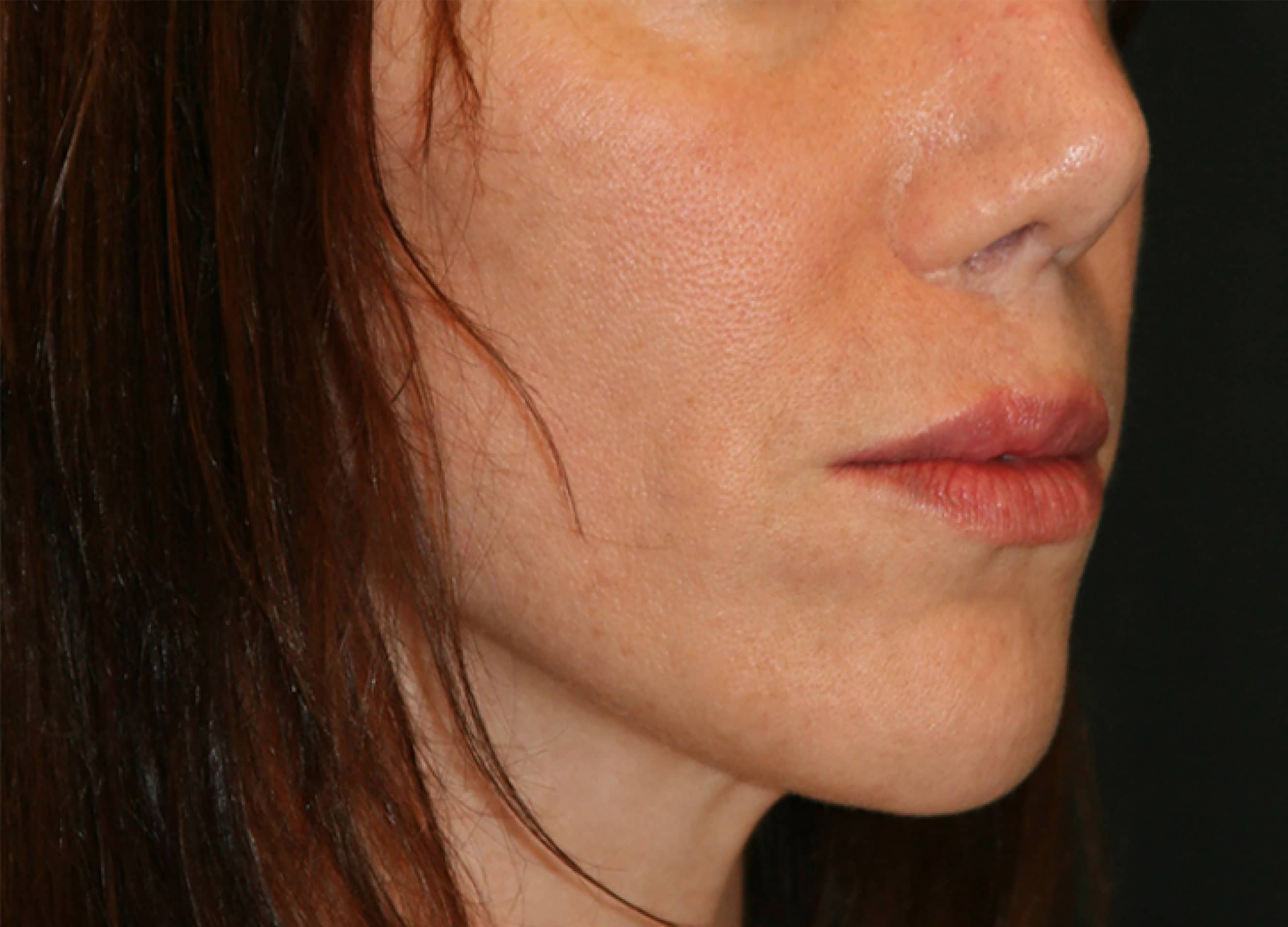 Classic Facelift Before & After