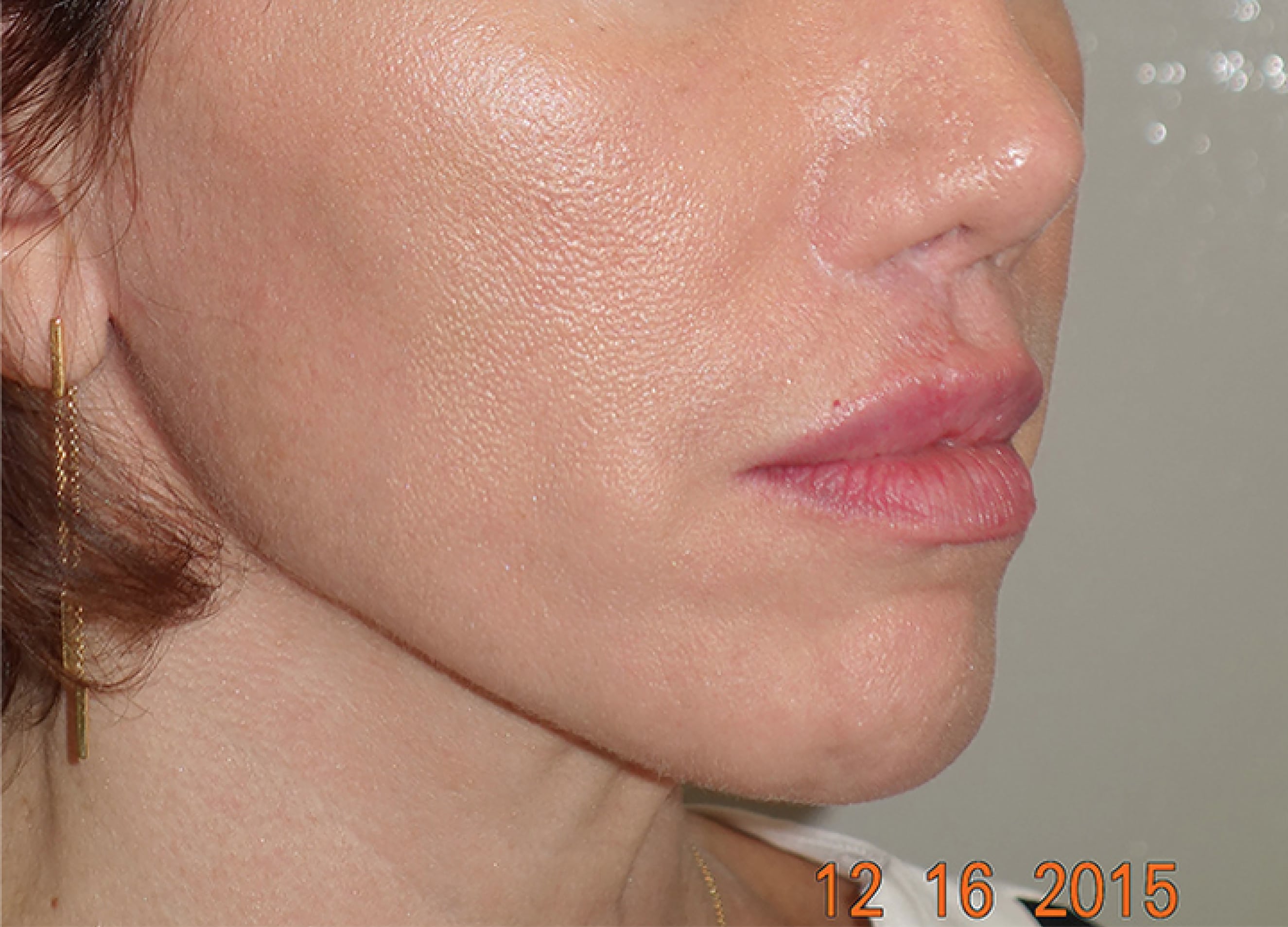 Classic Facelift After & After