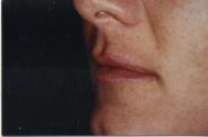 Classic Facelift Before & After