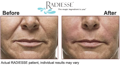 Radiesse Beverly Hills minimize aging