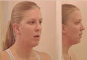 Swan Amy after Jaw implants, Browlift, Upper lip lift, Nosejob, Breast Lift, etc. by Dr Haworth, featuring Beverly Hills plastic surgeon Dr. Randal Haworth