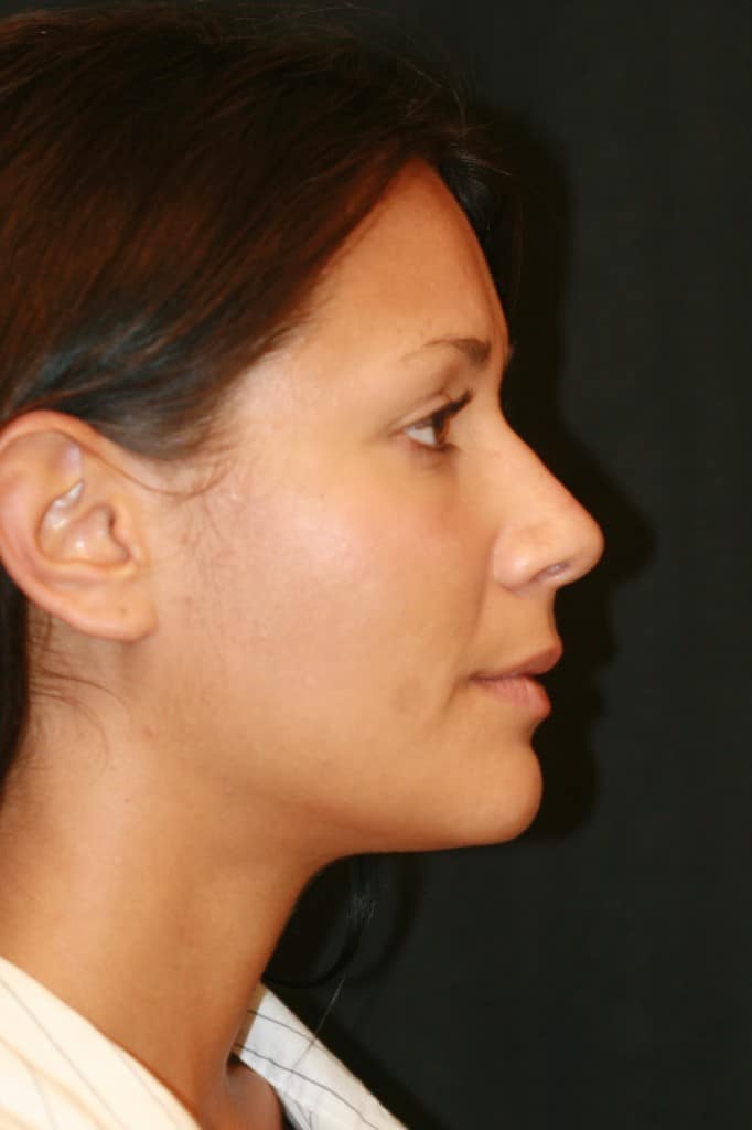 beverly hills nosejob, beverly hills rhinoplasty