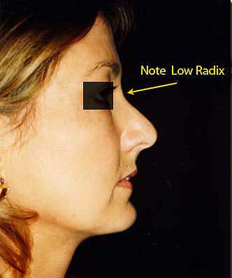 beverly hills nosejob, beverly hills rhinoplasty