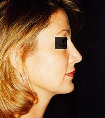 beverly hills nosejob, beverly hills rhinoplasty