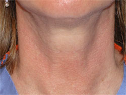 Horizontal Neck Lines, beverly hills nosejob, beverly hills rhinoplasty