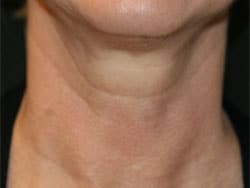 Horizontal Neck Lines, beverly hills nosejob, beverly hills rhinoplasty