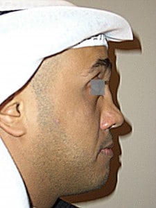 beverly hills nosejob, beverly hills rhinoplasty