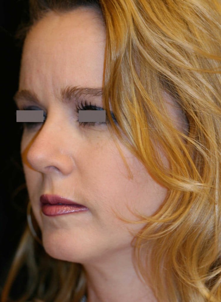 beverly hills nosejob, beverly hills rhinoplasty