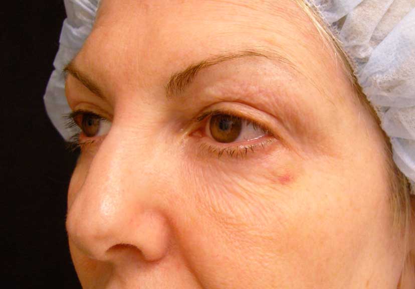 An alternative view of this patient with aging lower eyelids