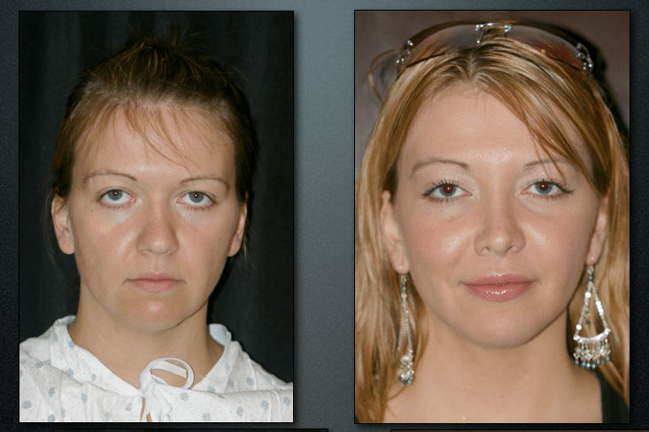 midfacelift, browlift, blepharoplasty, upper ,lip lift, fat transfer to lips