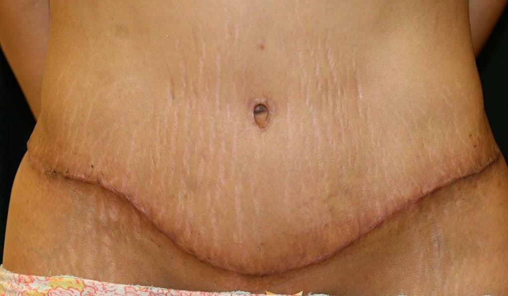 Abdominal Stretch Marks