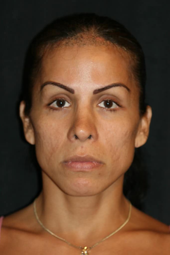 TS Preoperative transgender patient with retracted nostrils
