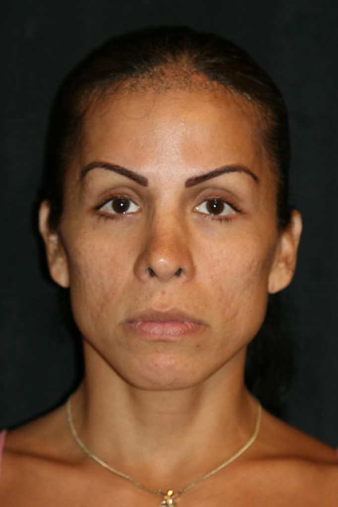 Preoperative transgender patient with retracted nostrils