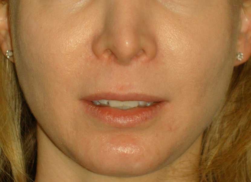 closeup-pre Patient with a long upper lip and retracted "Samurai"nostrils after a previous rhinoplasty