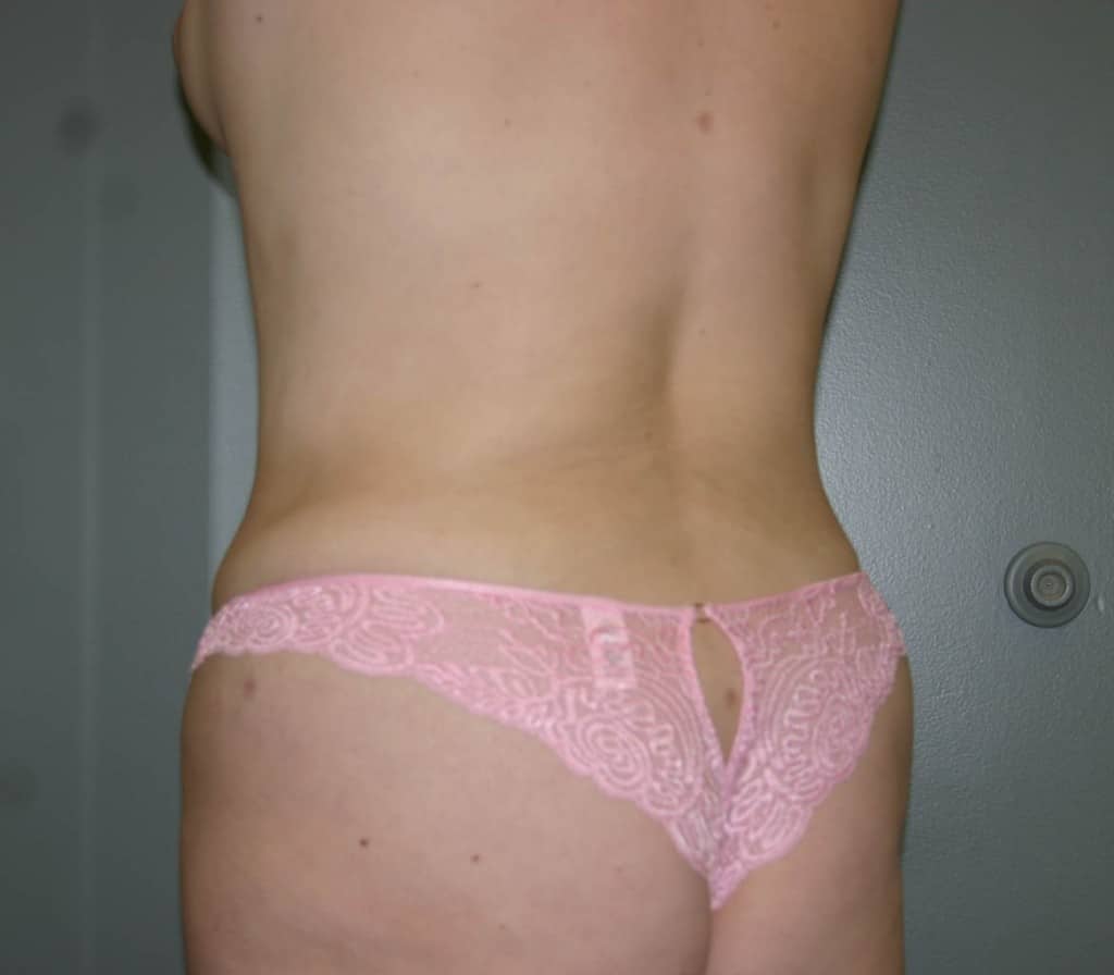 IMG_0433 After 360 Liposculpture of the abdomen and waist