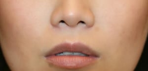 Patient with subliminal long upper lip with minimal upper toothshow