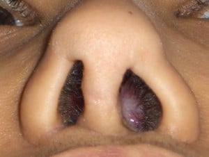 Poor rhinoplasty result with crooked , distorted tip and obvious nostril scarring after a Weir excision