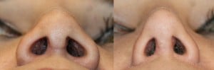 Before and after revision rhinoplasty and Weir excision as performed by Dr. RANDAL HAWORTH