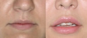 Primary rhinoplasty, Weir excision and concomitant upper lip lift as performed by Dr. Haworth
