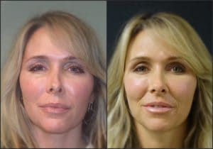 Bellafill injectable , non-surgical rhinoplasty