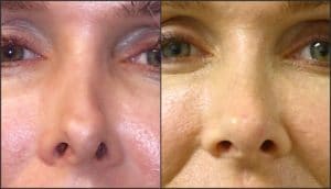 Bellafill injectable , non-surgical rhinoplasty