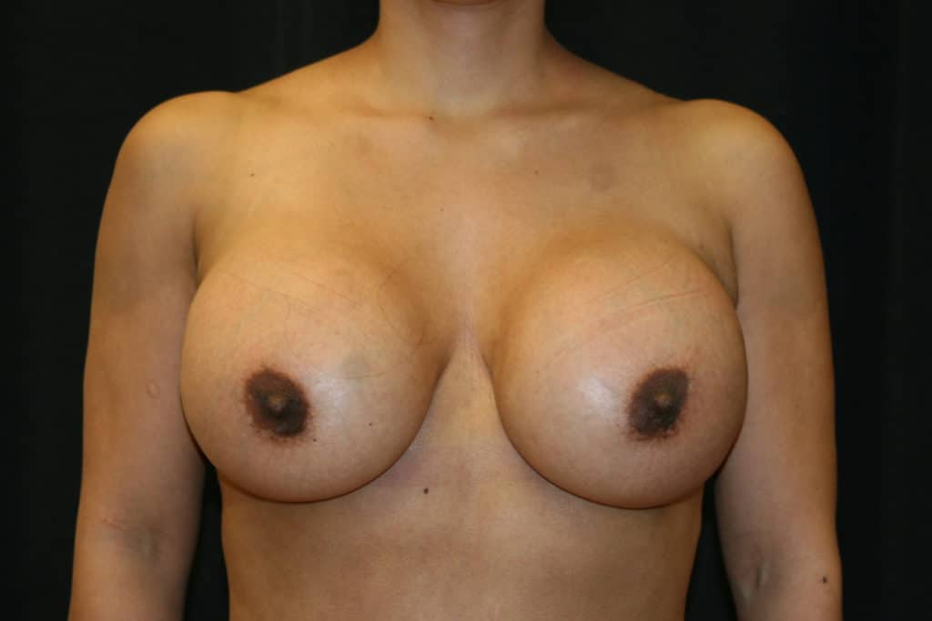 Fake pre-pectoral breast implants