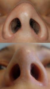 Open rhinoplasty