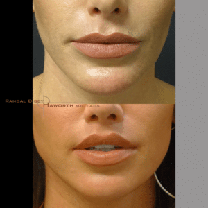 after OOS upper lip lift, corner lip lift and lower lip V-Y pasty