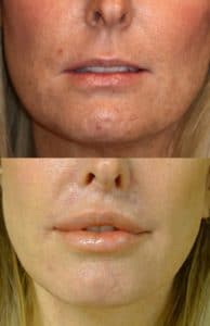 after upper lip lift by dr haworth, corner lip lift and lower lip v-Y plasty